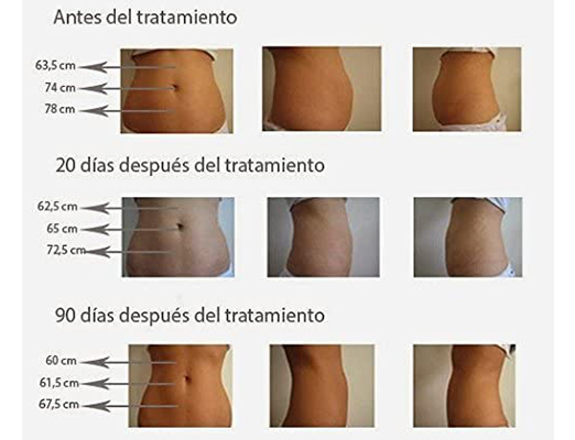 Presoterapia antes y después del tratamiento cintura